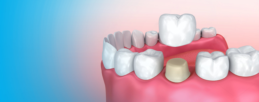 Dental Crowns and Bridges Treatment in Salmiya