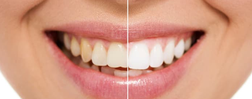 Teeth Bleaching and Whitening Treatment in Salmiya