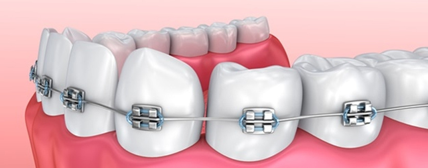 Dental Braces Treatment in Salmiya