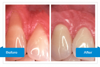Crowded and Misaligned Teeth Treatment Centre